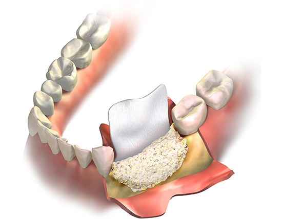 Bone Grafting | Alberta Academy of Periodontics | Periodontists | Alberta