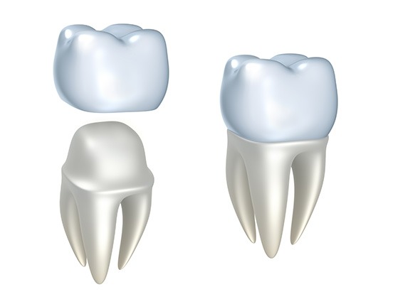 Crown Lengthening | Alberta Academy of Periodontics | Periodontists | Alberta