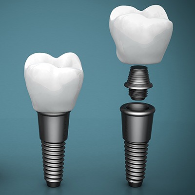 Dental Implants | Alberta Academy of Periodontics | Periodontists | Alberta