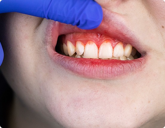 Gum Disease Stages | Alberta Academy of Periodontics | Periodontists | Alberta