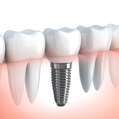 Peri-Implant Disease | Alberta Academy of Periodontics | Periodontists | Alberta