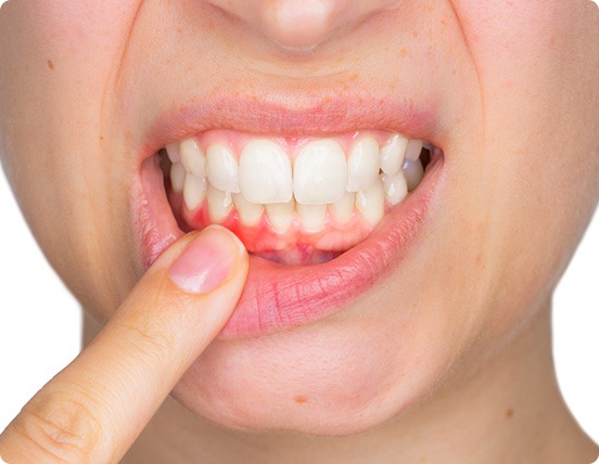 Bleeding Gums | Alberta Academy of Periodontics | Periodontists | Alberta