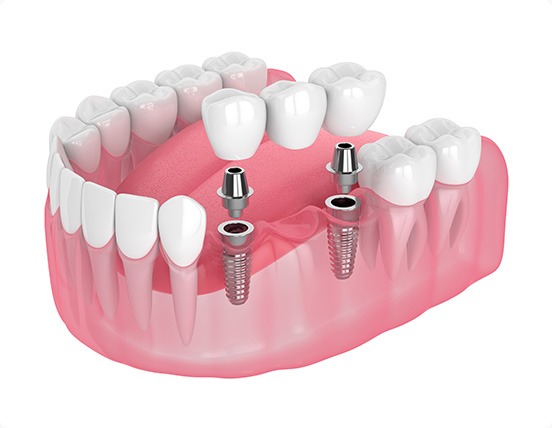 Dental Implants | Alberta Academy of Periodontics | Periodontists | Alberta